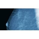 Befundmonitore für Mammographie